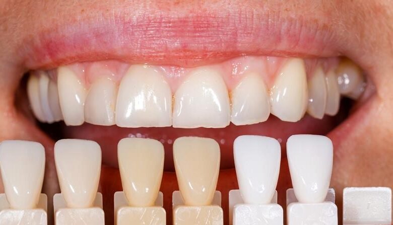 Porcelain Veneers